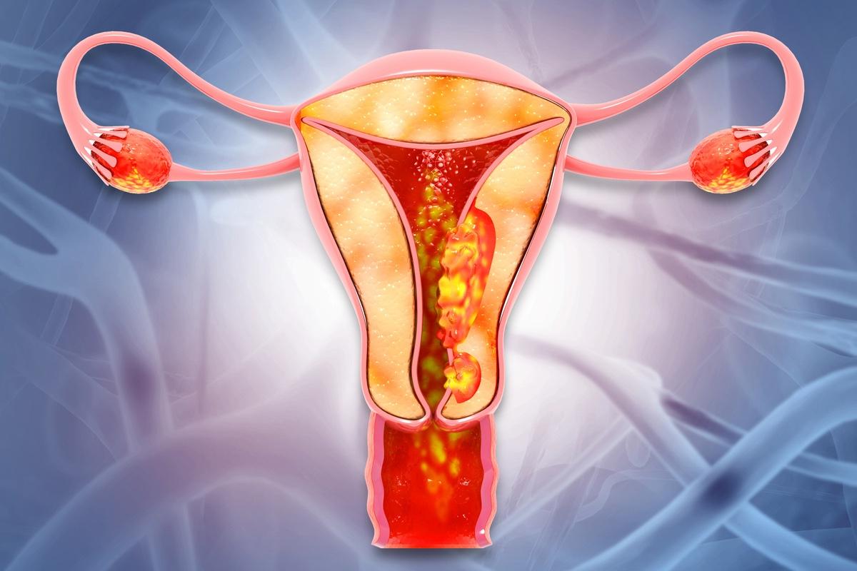 Cancer de l'endomètre métastatique : une triple association
