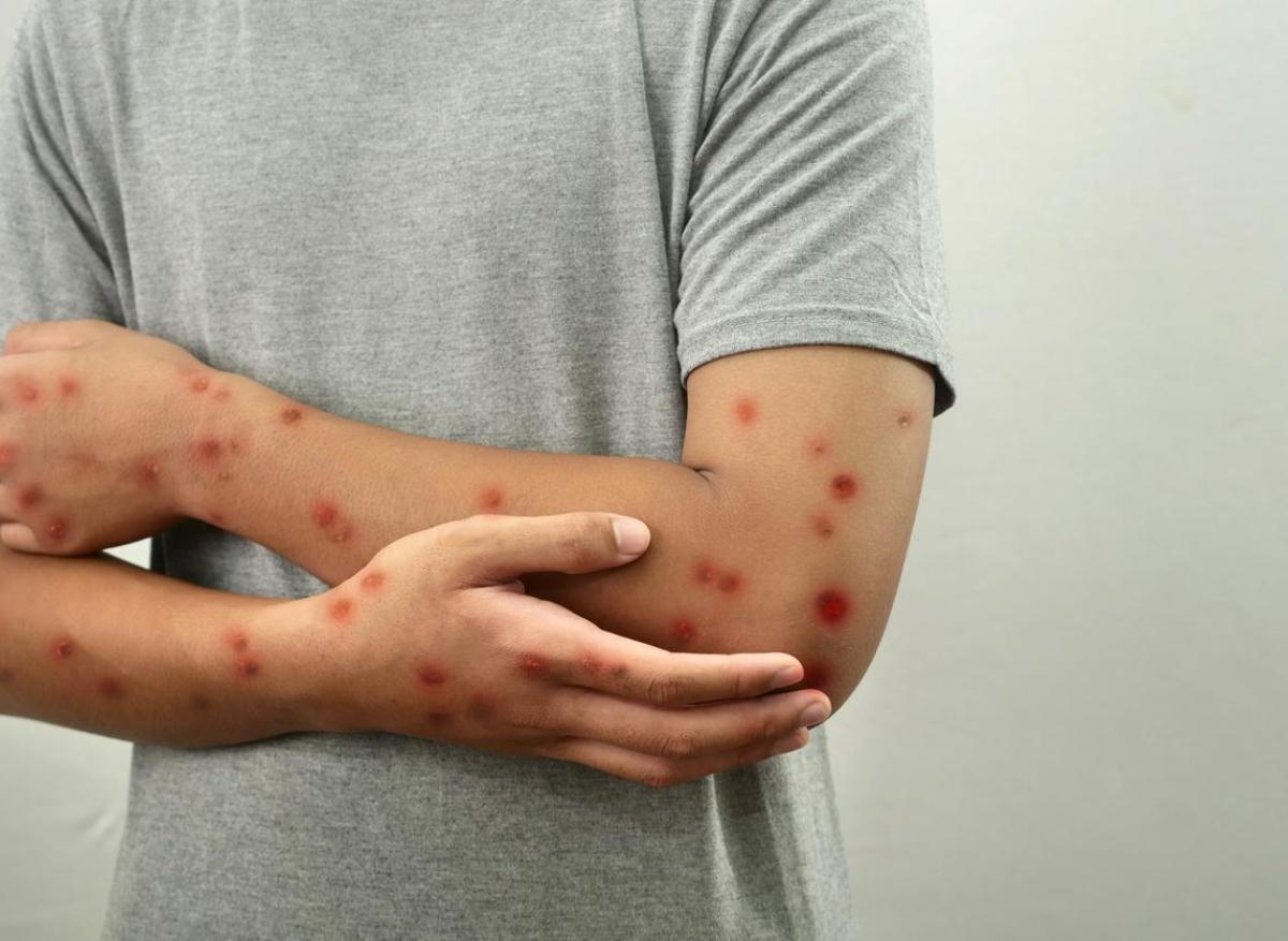 Variole du singe : le Mpox n’est pas le nouveau Covid-19