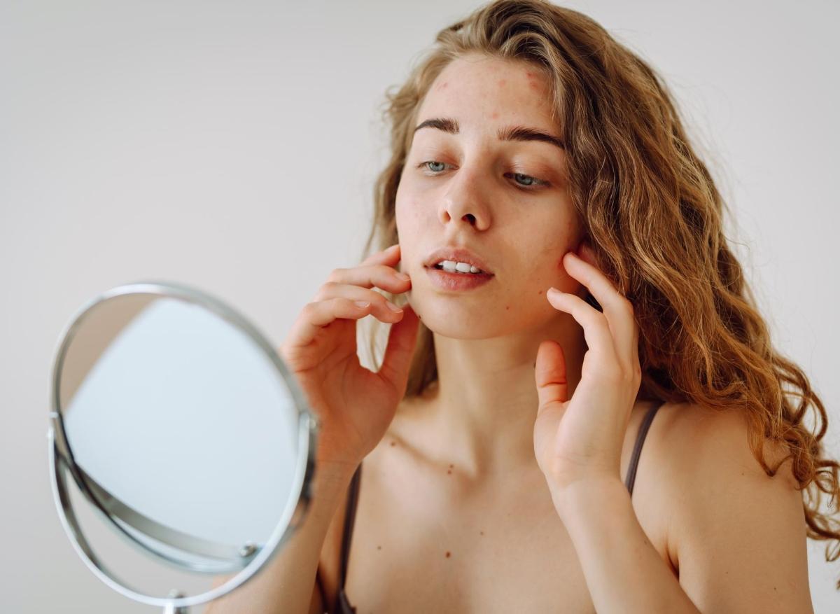 Acné : l'isotrétinoïne efficace lors du traitement hormonal masculinisant