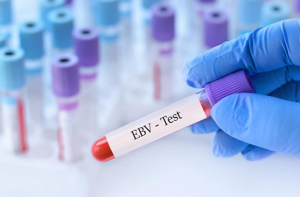 Sclérose en plaques : rôle avéré des infections à EBV de l’enfance