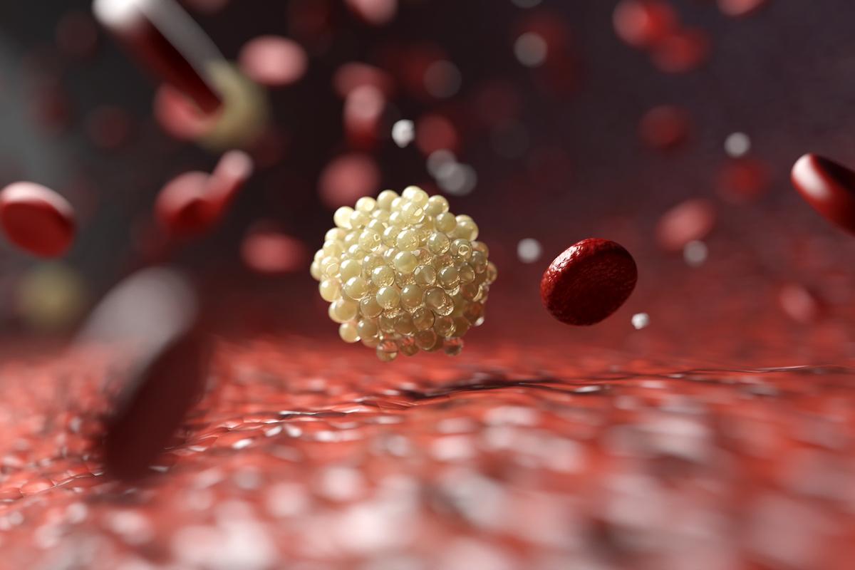 Risque cardiovasculaire : un ARN interférent réduit durablement la lipoprotéine(a)