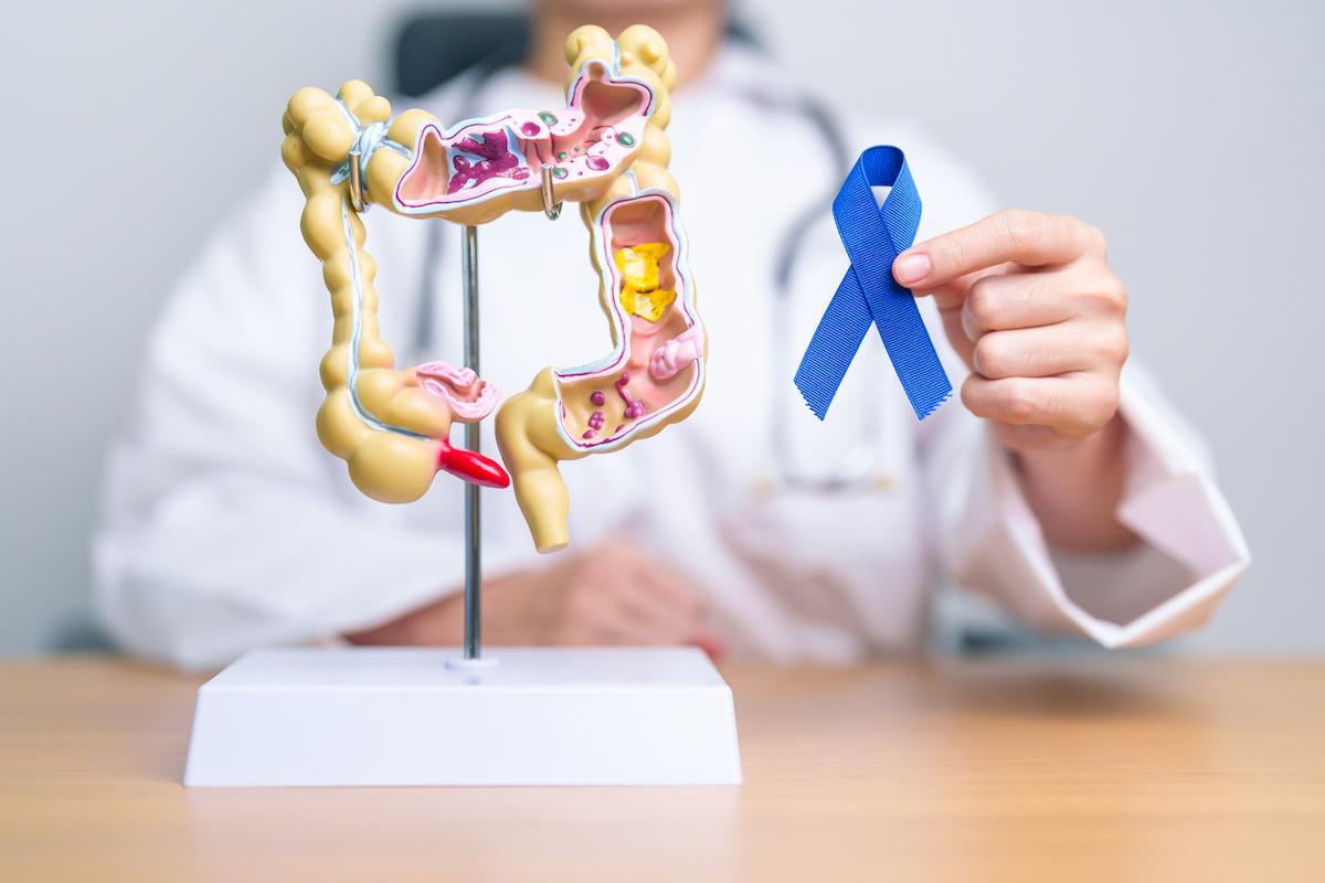 Tumeurs solides dMMR précoces : l’immunothérapie révolutionne le traitement 