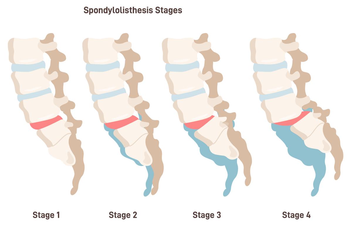 Spondylolisthésis dégénératif : la décompression ferait aussi bien que l'arthrodèse