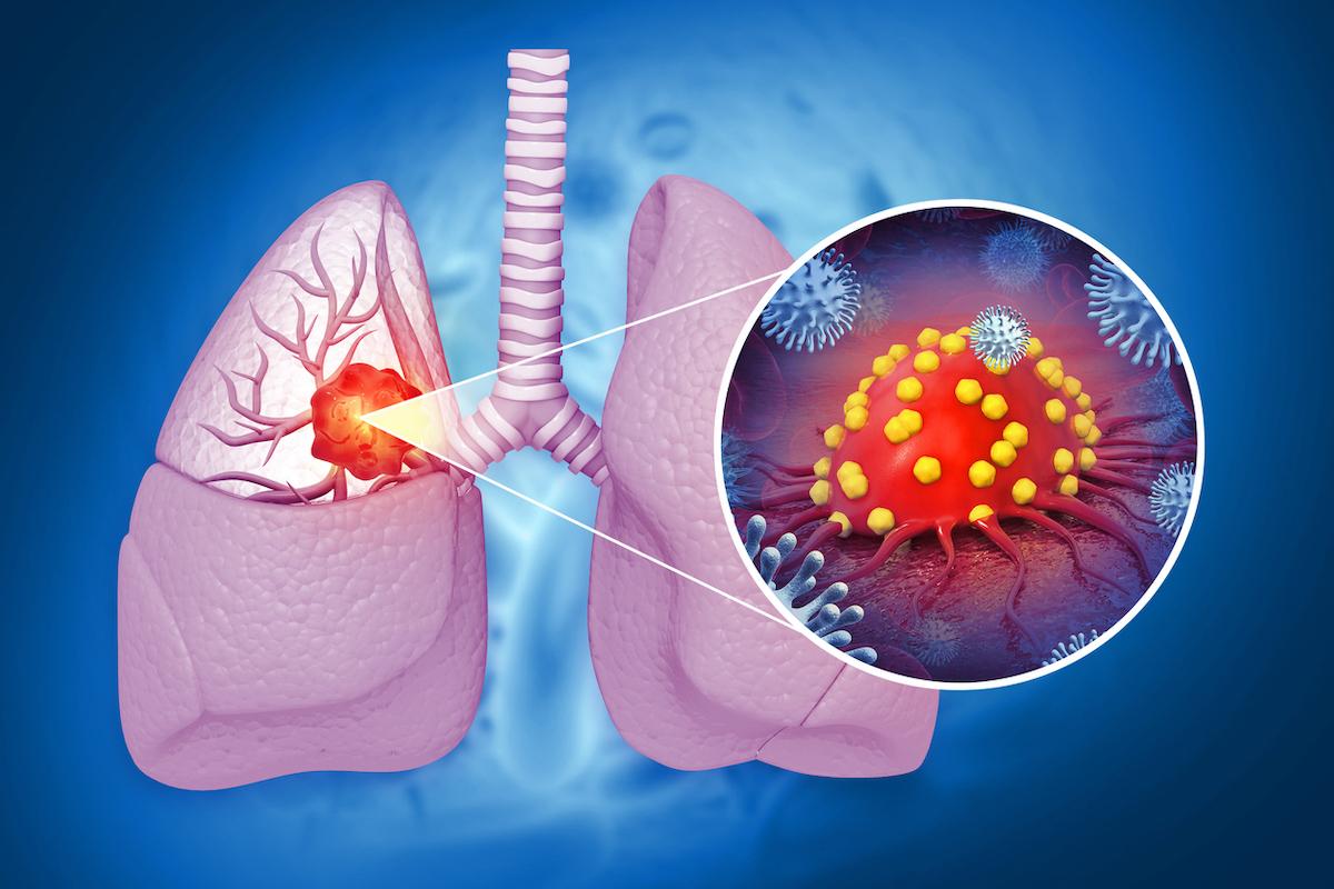 Cancer bronchique NPC KRAS G12C : un biomarqueur prédictif de la réponse au sotorasib 