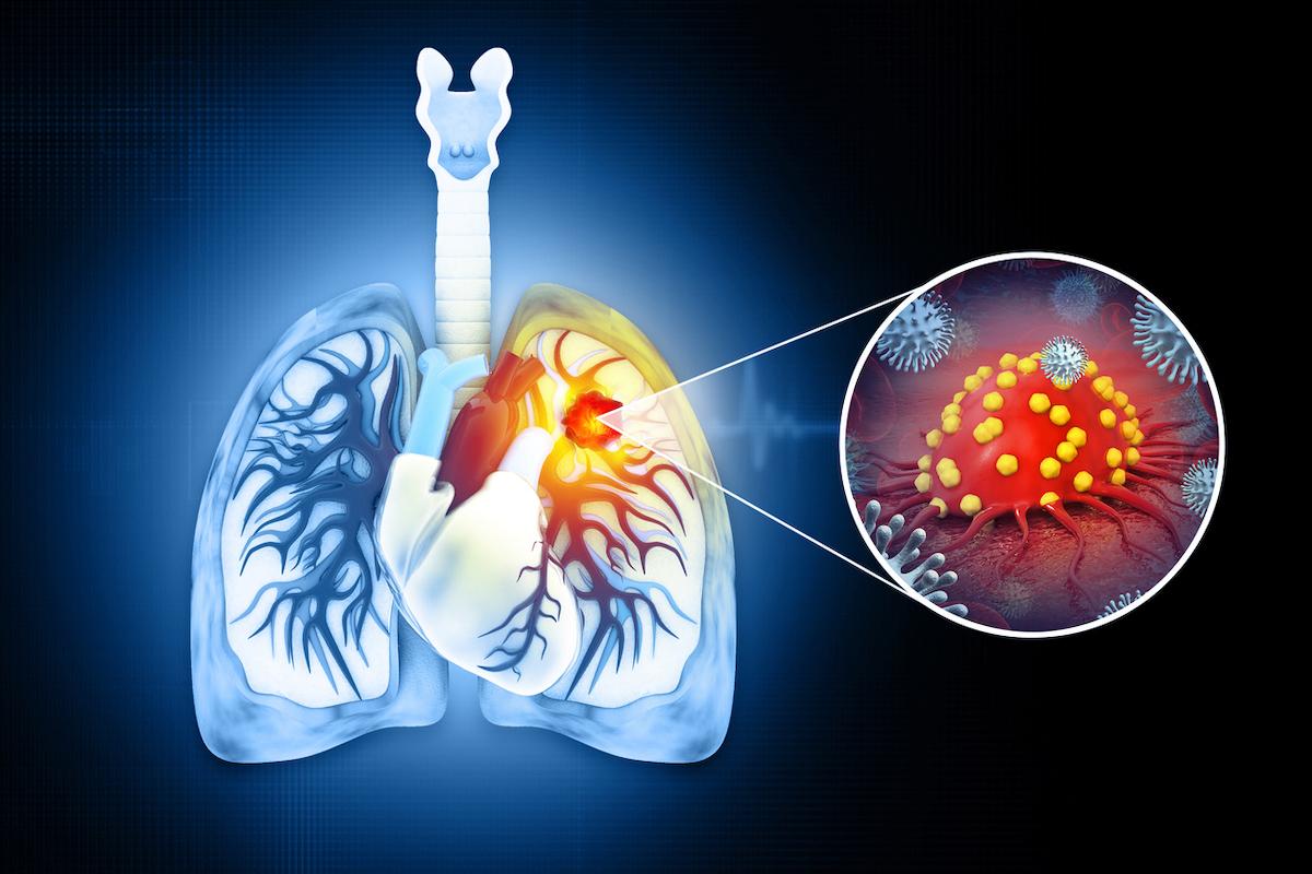 Cancer bronchique NPC résécable :  l’immunothérapie néoadjuvante change la donne