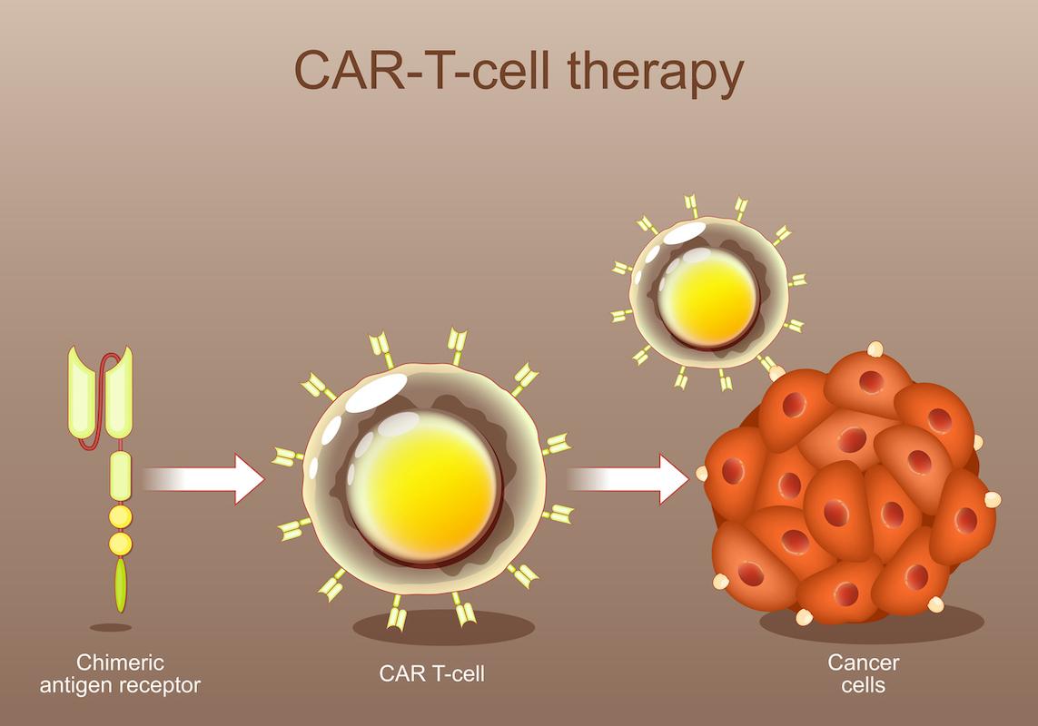 CAR-T : un risque faible de cancers secondaires après traitement 