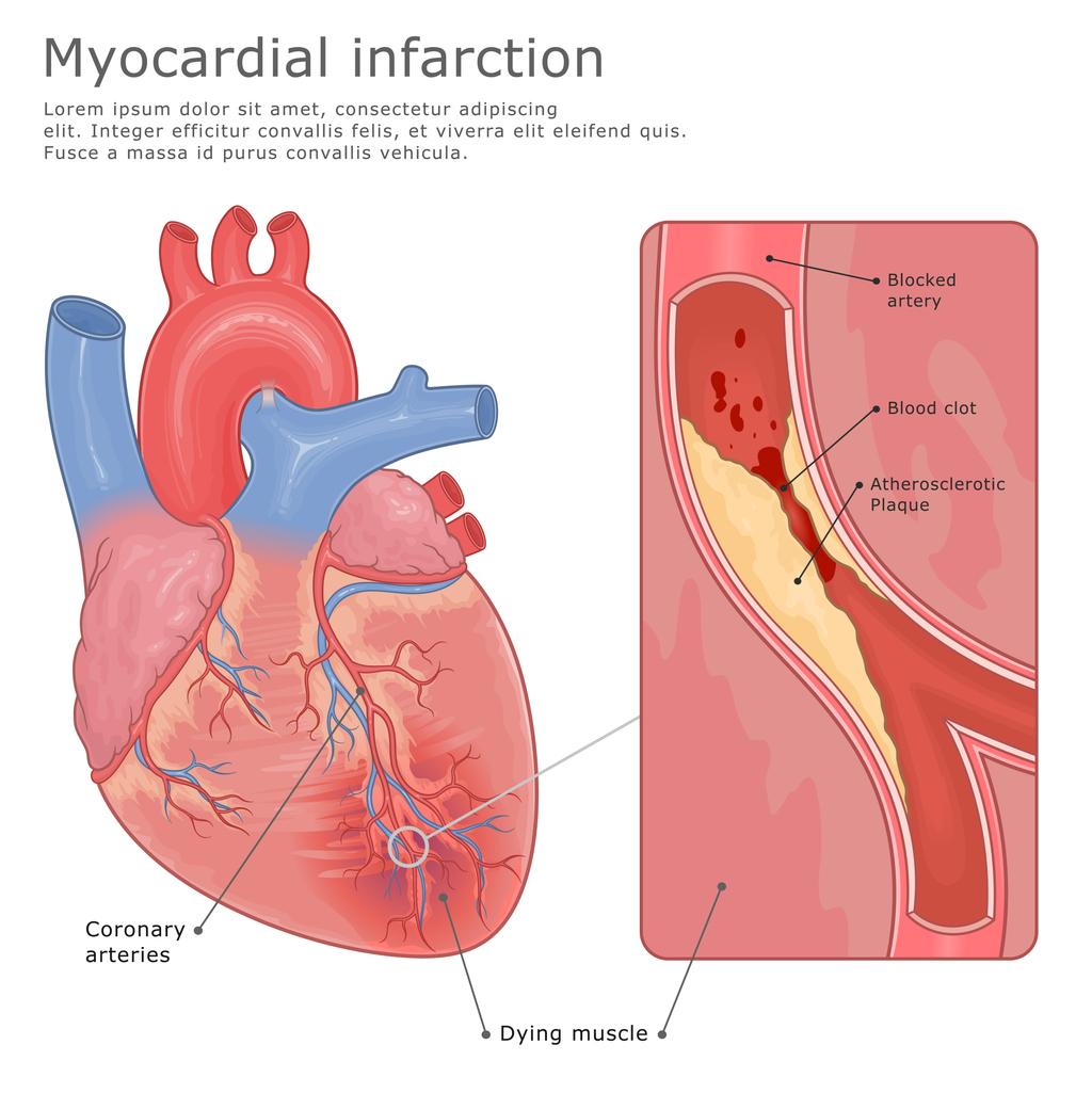Infarctus du myocarde : la spironolactone n'est pas systématique