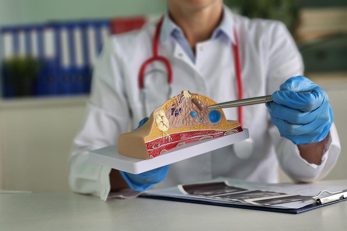 Cancers du sein RH+ HER2- métastatiques : EMBER3, imlunestrant + abémaciclib en 2ème ligne