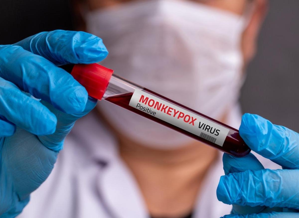 mpox : le variant clade 1b du virus  détecté en France 