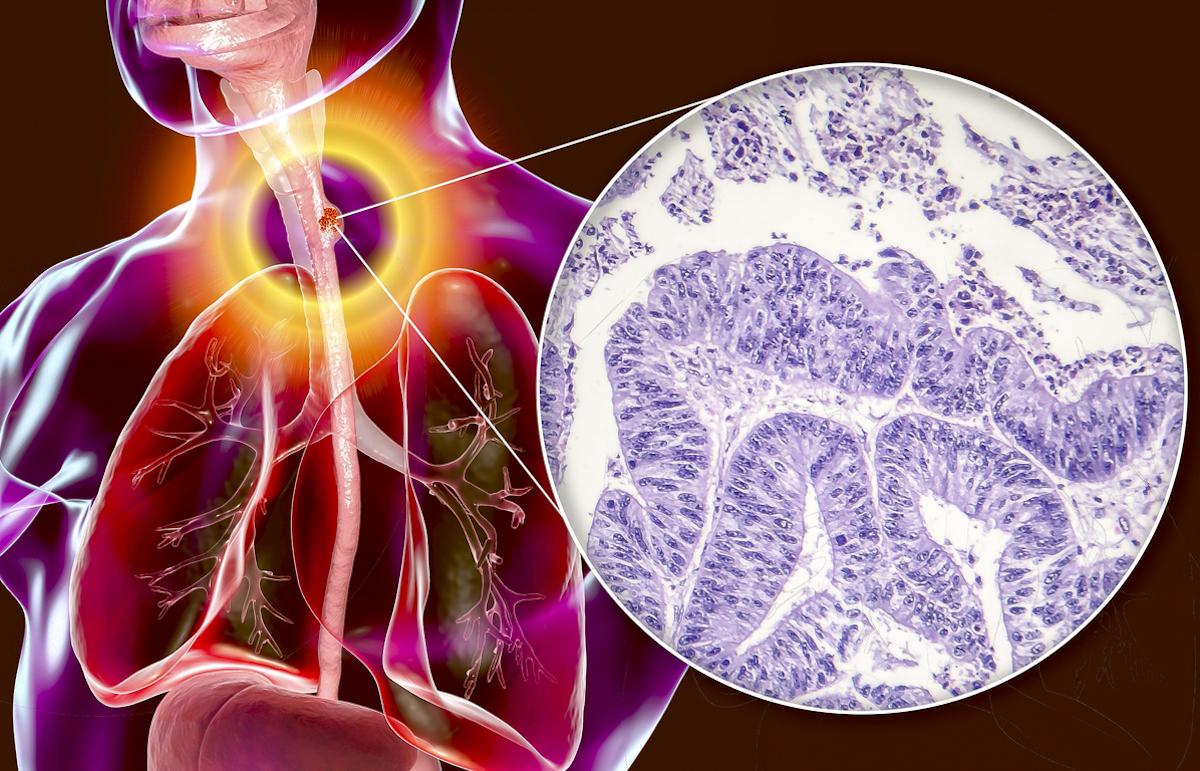 Adénocarcinome de l’œsophage résécable : la chimiothérapie périopératoire par FLOT est un nouveau standard 