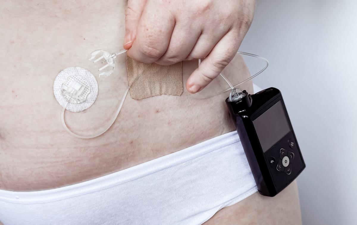 Diabète de type 2 insulinodépendant : efficacité démontrée du pancréas artificiel 