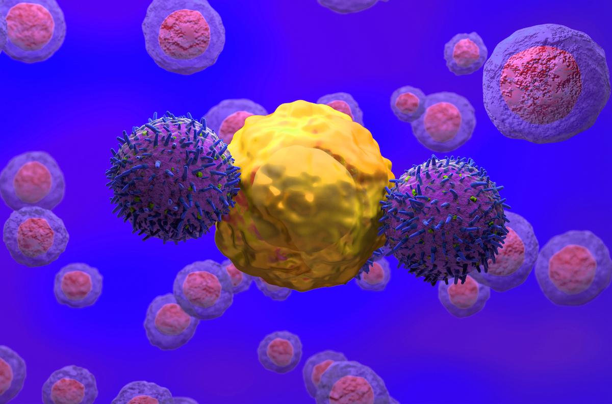 Lymphome B diffus à grandes cellules : résultats intéressants des CAR T-cells allogéniques 