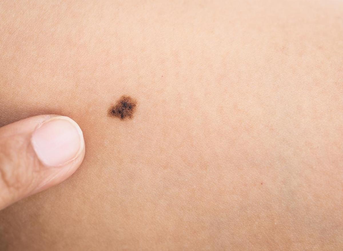Mélanome : un patch à bioélectronique pour une détection précoce