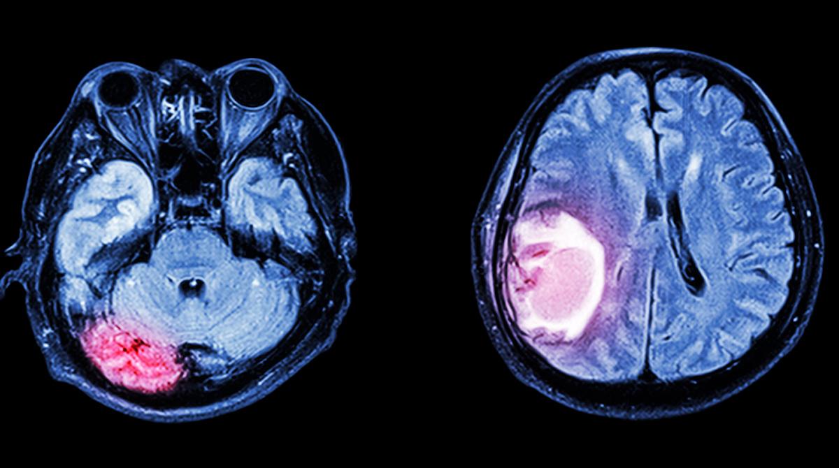 FA après hémorragie cérébrale : les AOD probablement pas pour tous les patients
