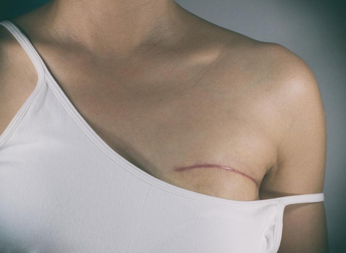Cancer du sein : la prise en charge intégrale des soins votée