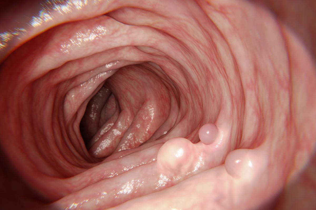 Dépistage du cancer colorectal : colonoscopie ou test immunologique fécal ?