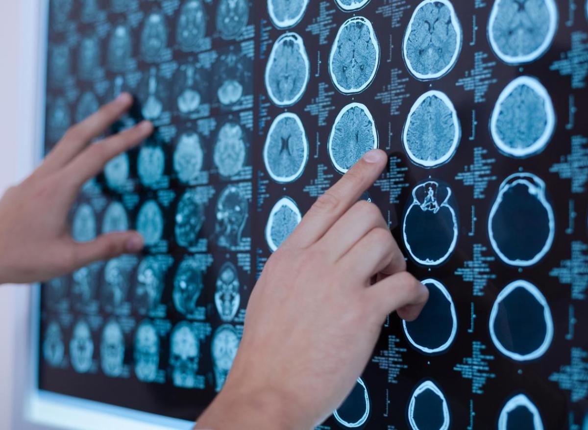 Méningiome inopérable : la radiothérapie plus efficace avec un radiosensibilisant