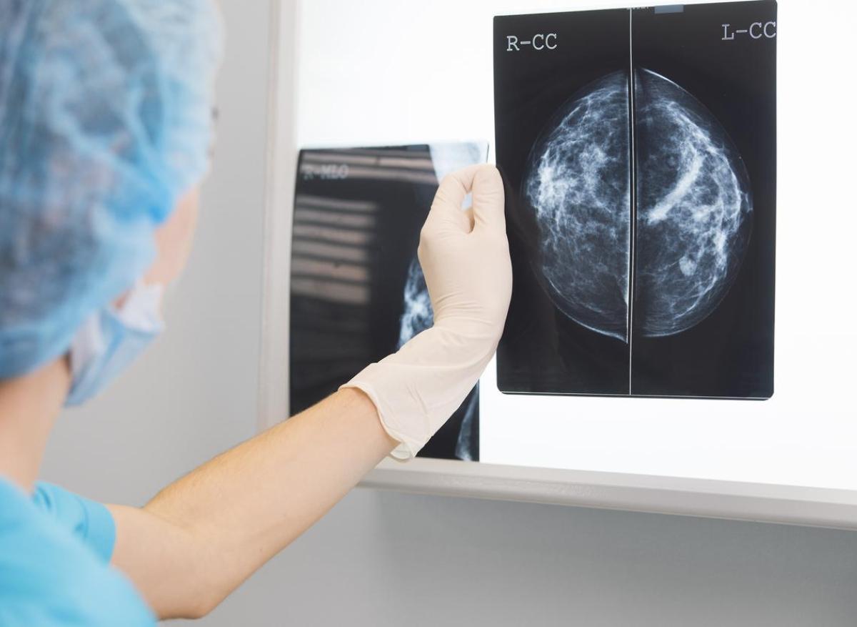 Cancer du sein triple négatif : une nouvelle cible thérapeutique identifiée