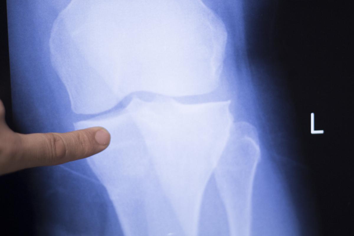 Gonarthrose : trop de radios peuvent nuire au traitement