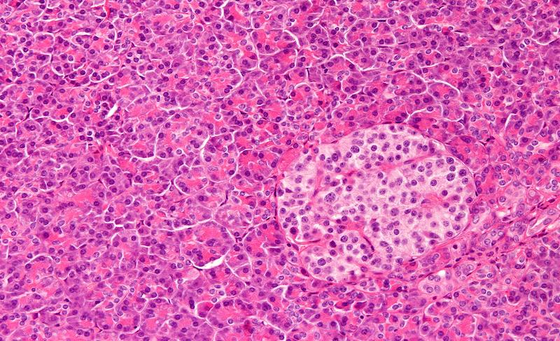 Diabète de type 1 : les infections à entérovirus de l’enfance associées à l’auto-immunité