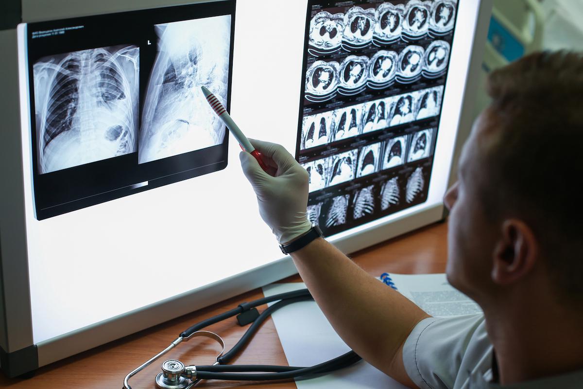 Bronchite chronique : les bouchons de mucus associé à la dégradation de la fonction respiratoire des BPCO