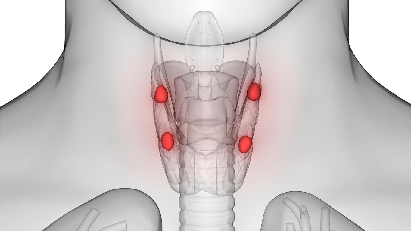 Hyperparathyroïdie primaire : pas d’impact de la parathyroïdectomie sur le risque de dépression 