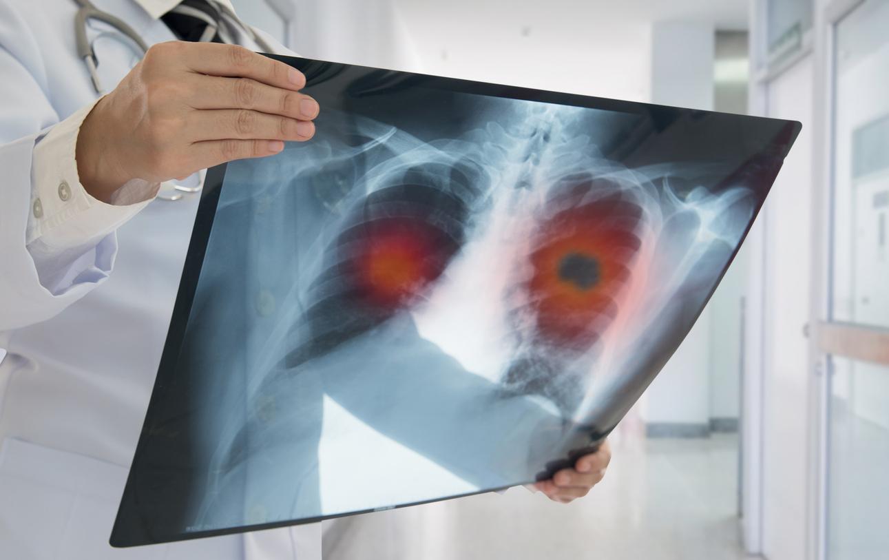 Cancer du poumon : d‘autres facteurs de risque que le tabagisme