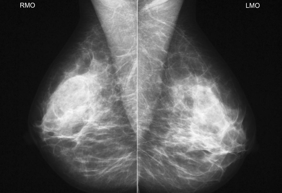 Cancer du sein : le risque affiné par le suivi de la densité des seins 
