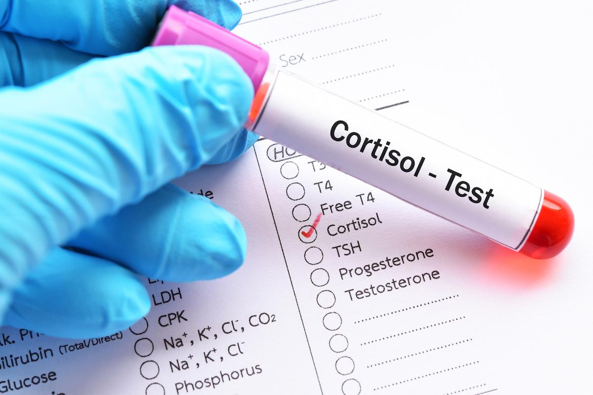 Diabète de type 2 mal contrôlé : un hypercorticisme non diagnostiqué fréquent ?