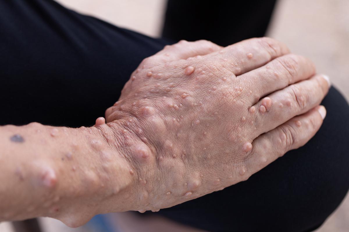 Neurofibromatose plexique inopérable : 1ère option crédible chez l’adulte NF1/PN