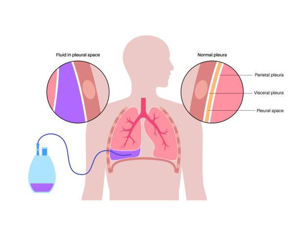 Pleurésies malignes récidivantes: intérêt de l’association d’un talcage pleural par thoracoscopie et d’un drain tunnelisé à demeure 