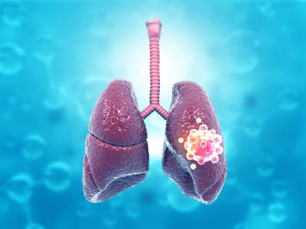 Actualisation des recommandations de prise en charge des pneumonies aiguës communautaires de l'adulte.