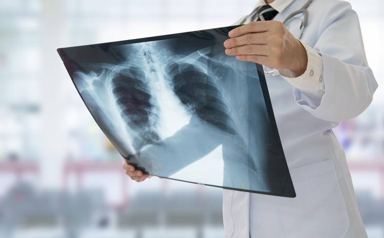 Insuffisance cardiaque et exacerbation de BPCO : une opportunité thérapeutique à ne pas manquer