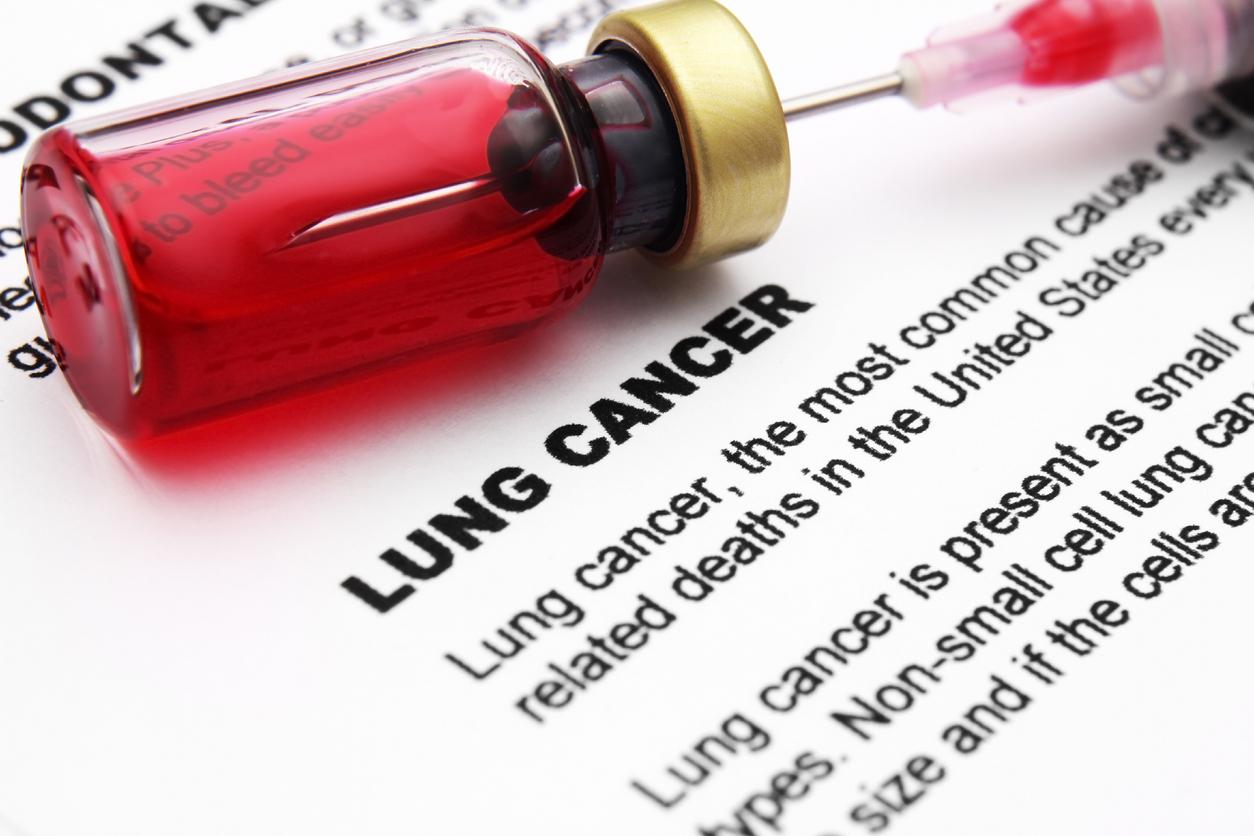 Cancer bronchique : les patients atteints meurent plus du COVID-19