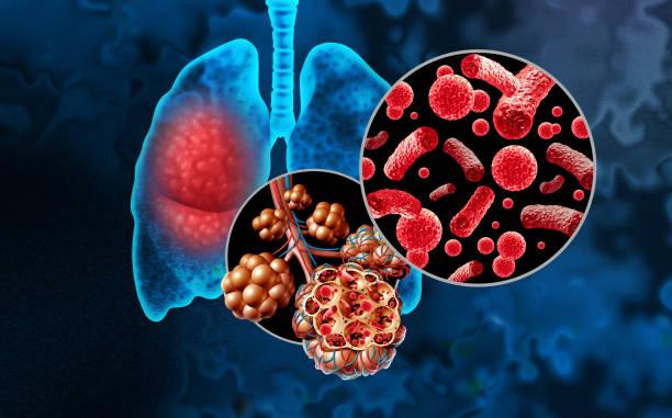 Papillomatose respiratoire récurrente, rare et dangereuse : à dépister !