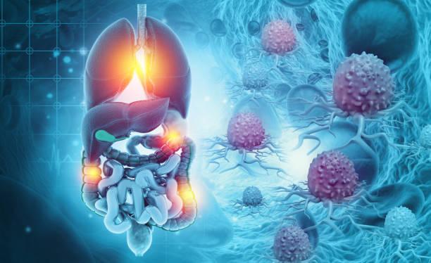  Bronchectasies associées aux maladies inflammatoires chroniques des intestins, pas si rares mais sous-diagnostiquées !