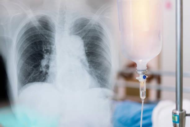 CBNPC résécables : intérêt des inhibiteurs de PDL1 en néoadjuvant