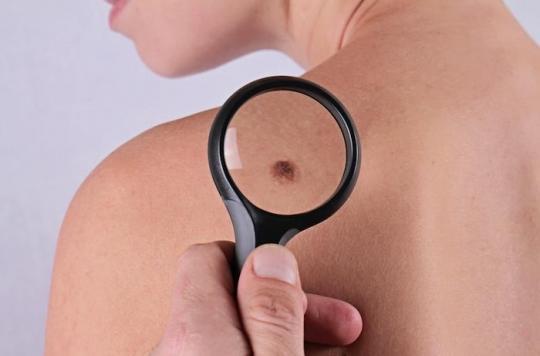 Mélanome à haut risque : réduction de 43 % du risque de rechute avec le pembrolizumab
